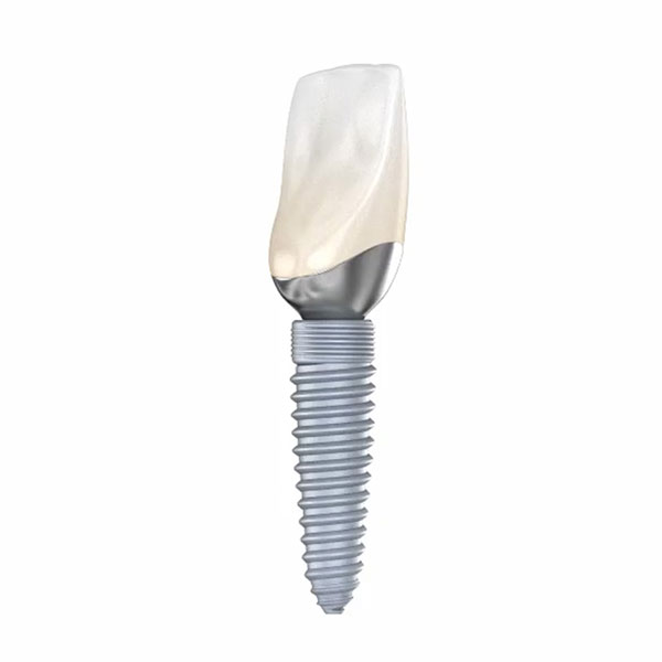graphic of a dental implant